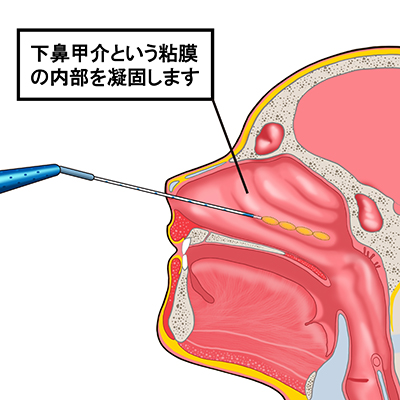 粘膜下下鼻甲介凝固術