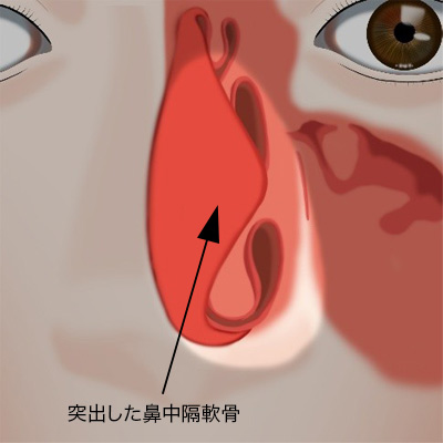 突出した鼻中隔軟骨のイメージ
