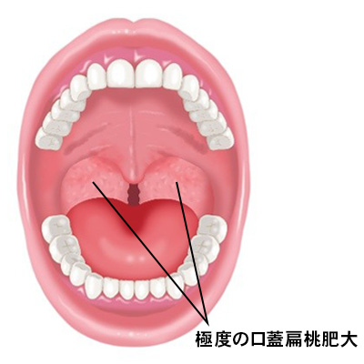 口蓋扁桃が極度に肥大しているイメージ