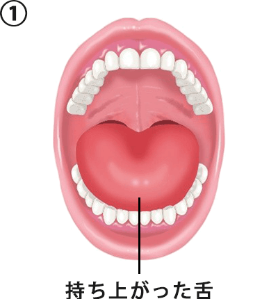 ② 軟口蓋が低い