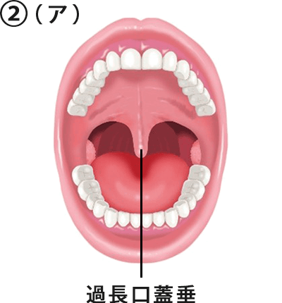 ②（ア）口蓋垂が長い