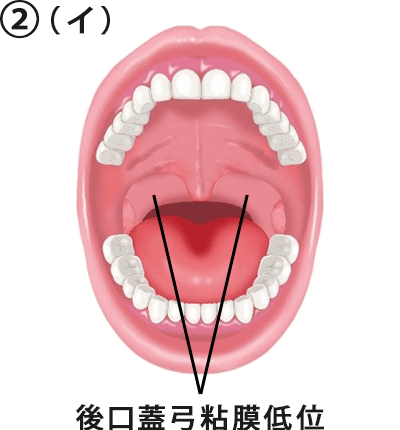 ② （イ）後口蓋弓粘膜が下方まで及んでいる