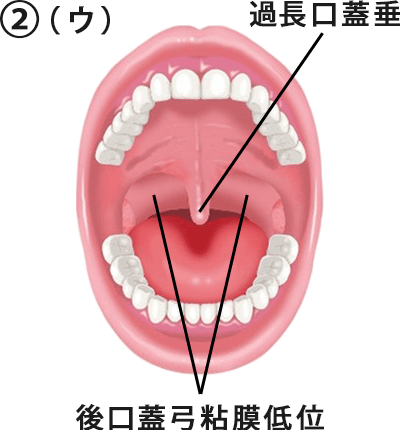 ② （ウ）口蓋垂が長く後口蓋弓粘膜が下方まで及んでいる