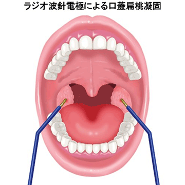 ラジオ波による口蓋扁桃凝固術①