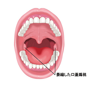 ラジオ波による口蓋扁桃凝固術②
